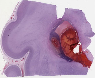 fetal germinal matrix hermorrhage